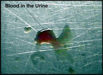 Pain when urinating, blood