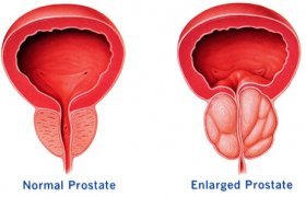 Health prostate problems