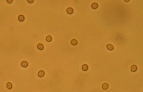 Microscopic blood in urine
