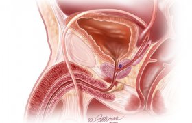 Prostate cancer and ejaculation