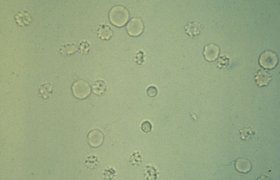 White blood Cells in urine